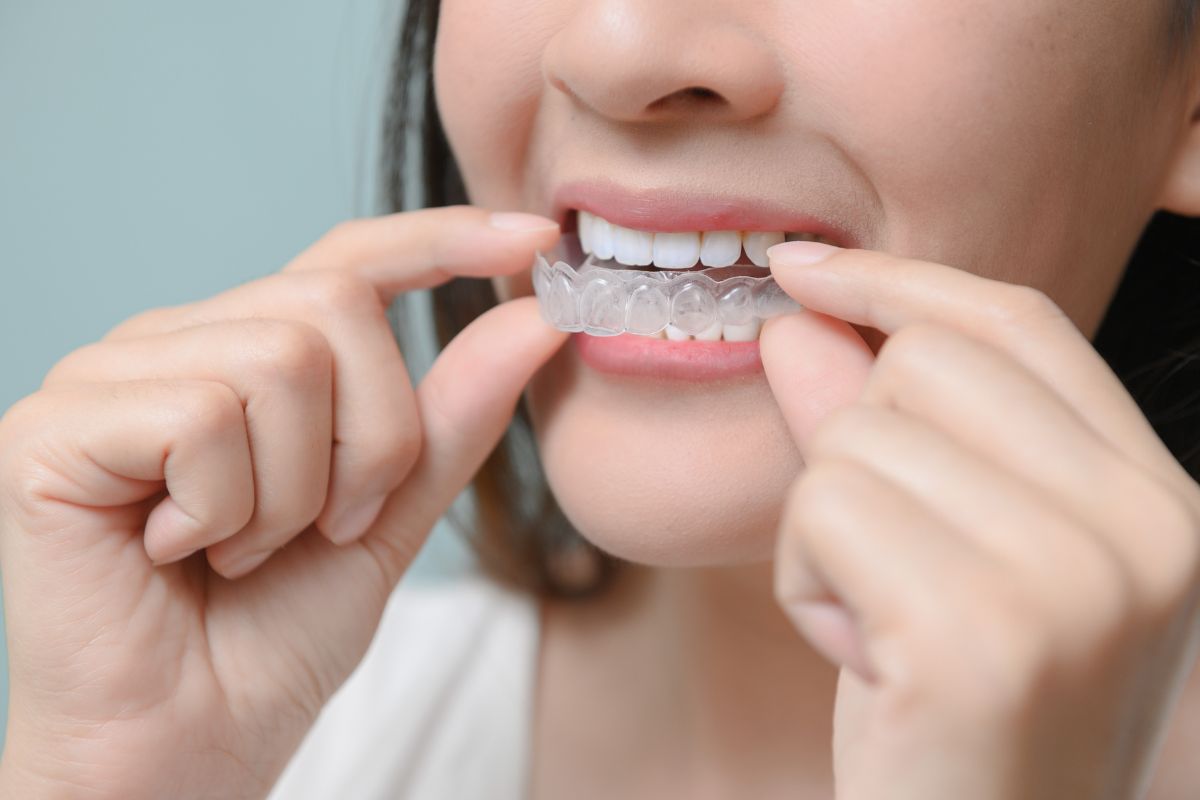 4 Things To Know About SureSmile Clear Aligners 