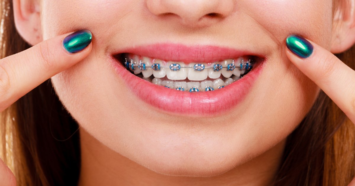 A close-up of a woman's smiling mouth, revealing she has braces. She points to her cheeks with her fingers, which have emerald nail polish.