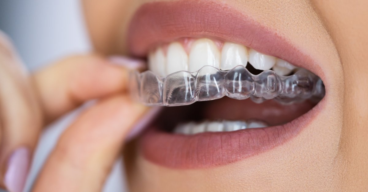 A close-up of a woman holding a set of dental aligners between her finger tips, aligning it with her top row of teeth.