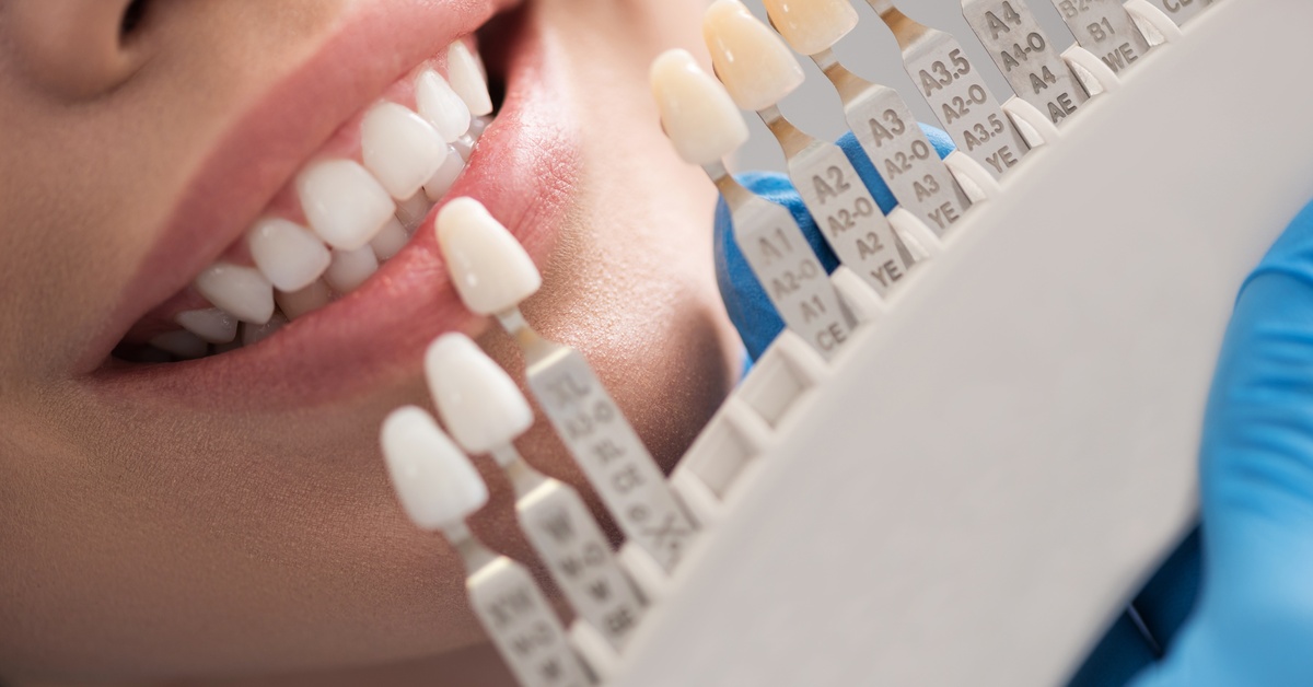 A woman's mouth is smiling alongside a gloved hand holding a display with different shades of tooth enamel options.