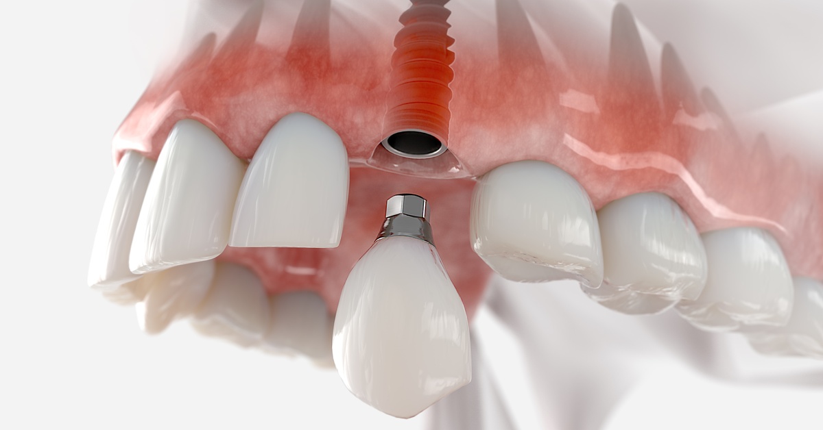 An illustration of a dental implant about to be installed into an upper set of teeth and gums, on a white background.