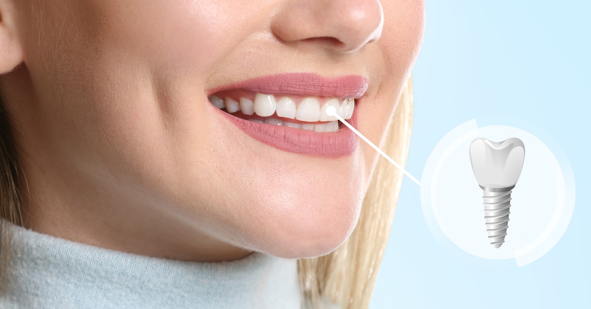 A close-up of a woman's smile, alongside an illustration of a dental implant with a line connecting it to the woman's tooth.