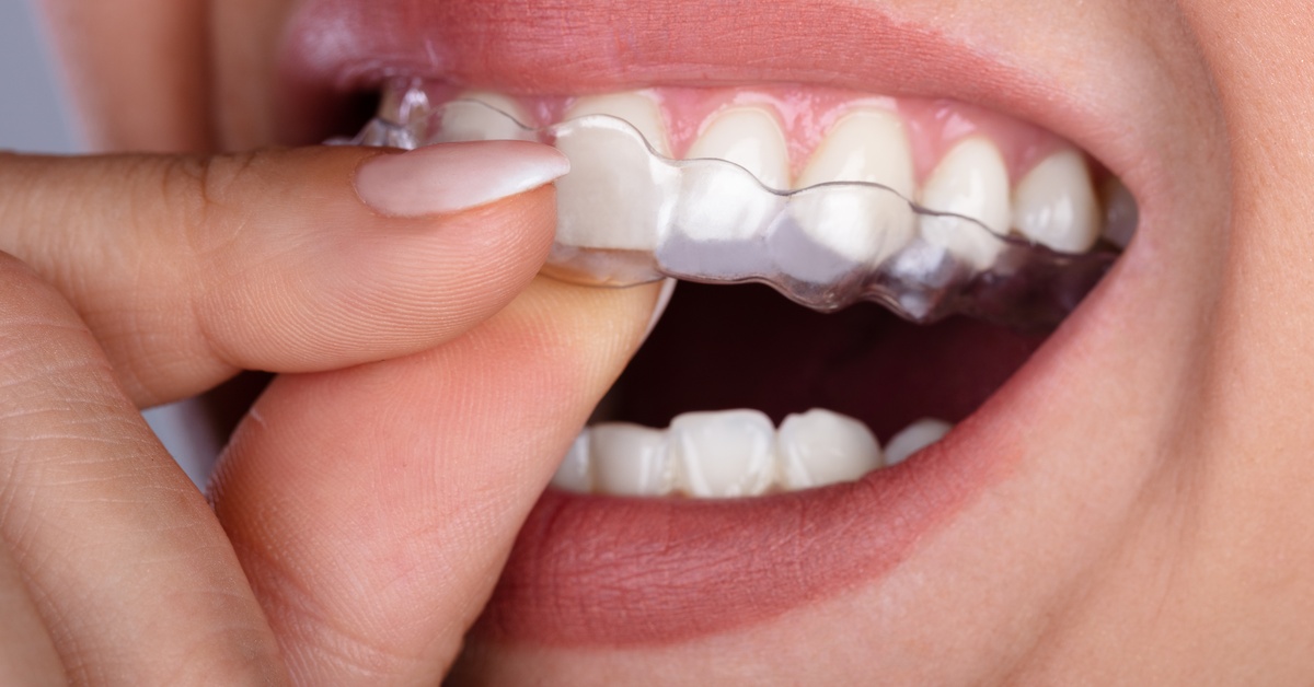 A close-up of a woman's fingers placing a set of clear teeth aligns on the top set of her teeth. She is wearing red lipstick.