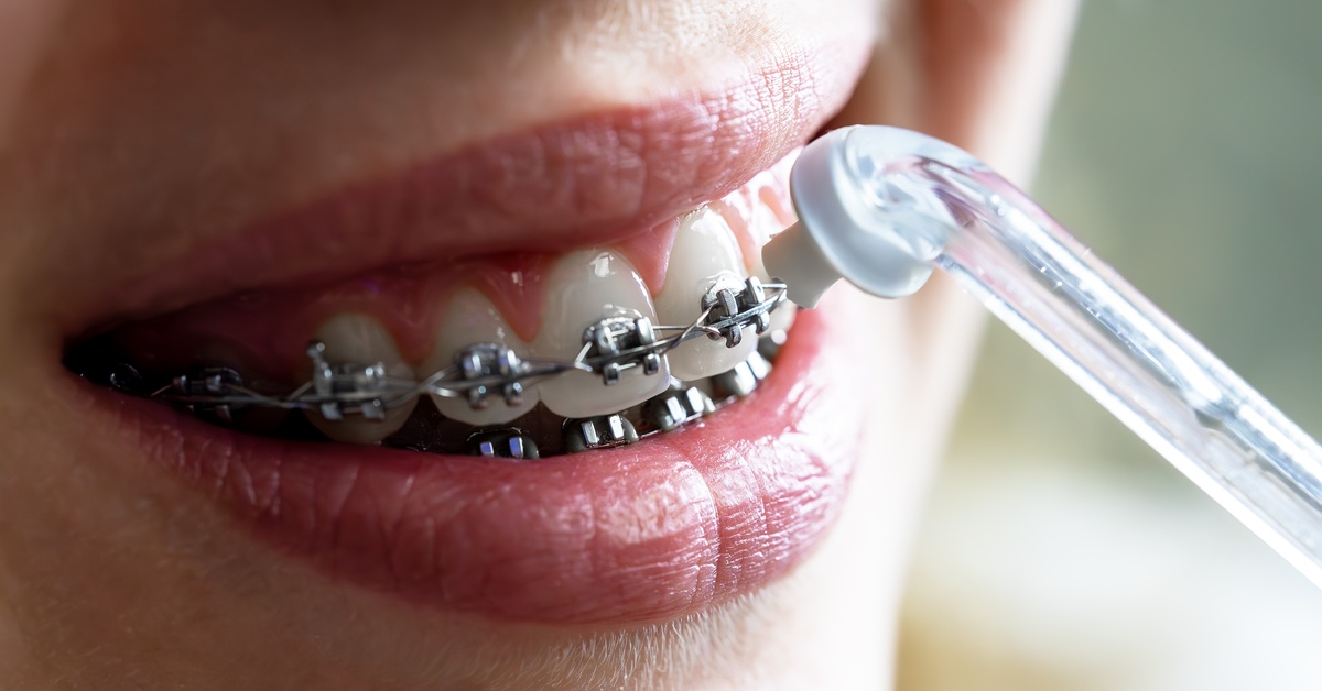 A close-up of a person's mouth with a set of braces on the top and bottom teeth. A water flosser is held up to the mouth.