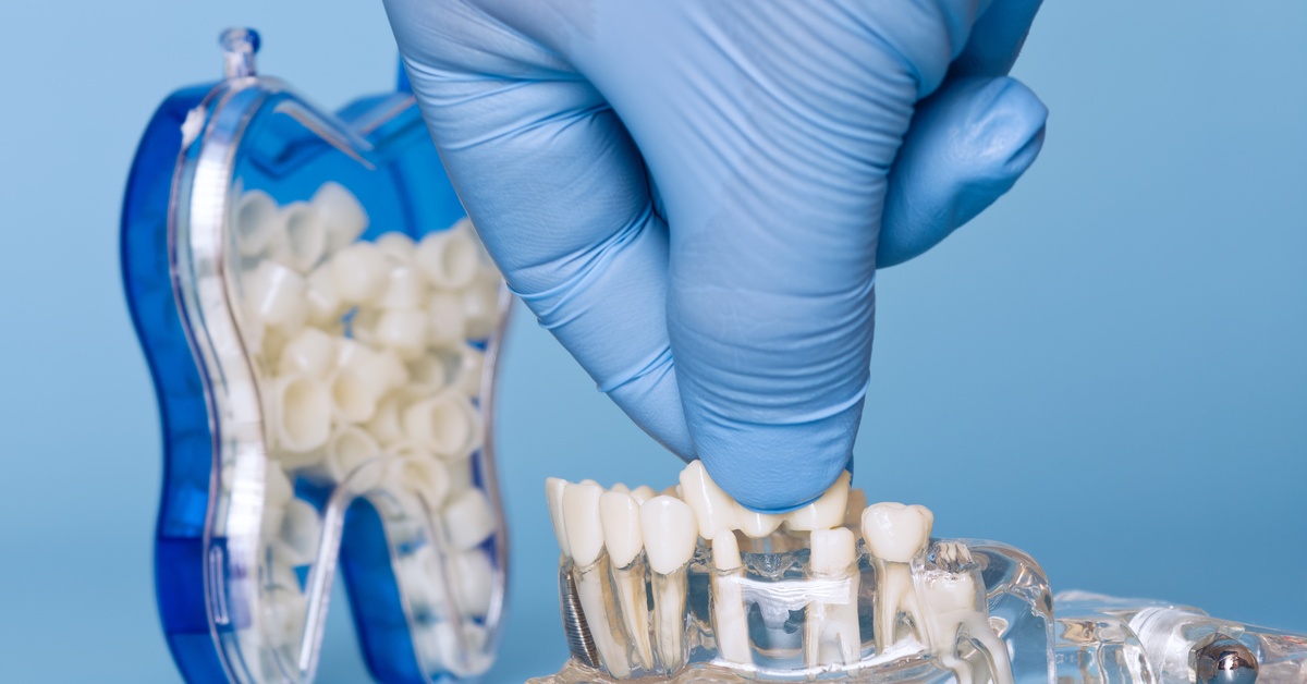 A gloved hand places a dental crown on a model of teeth against a blue background next to a container in the shape of a tooth.