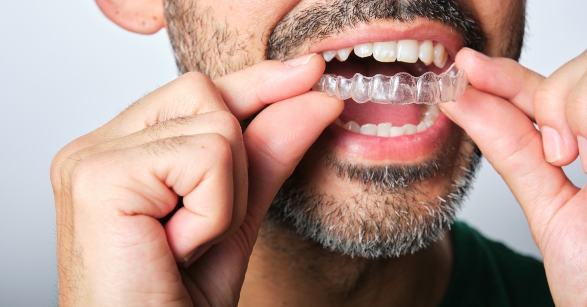 A close-up of a man placing a clear aligner onto his upper teeth, showing removable orthodontic treatment in use.