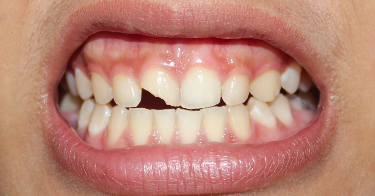 A close-up of a smile showing a chipped upper front tooth, with visible enamel damage and surrounding healthy teeth.