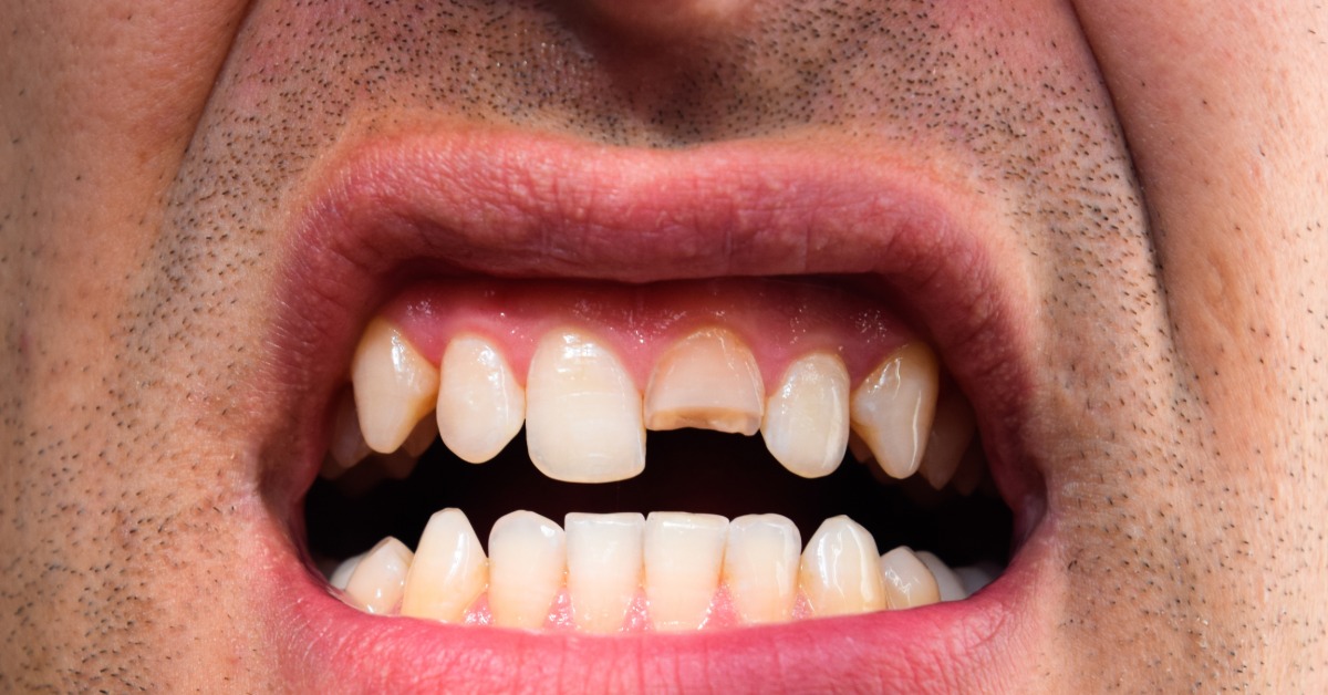A close-up of an open mouth showing a chipped upper front tooth, uneven tooth edges, and visible damage to enamel.