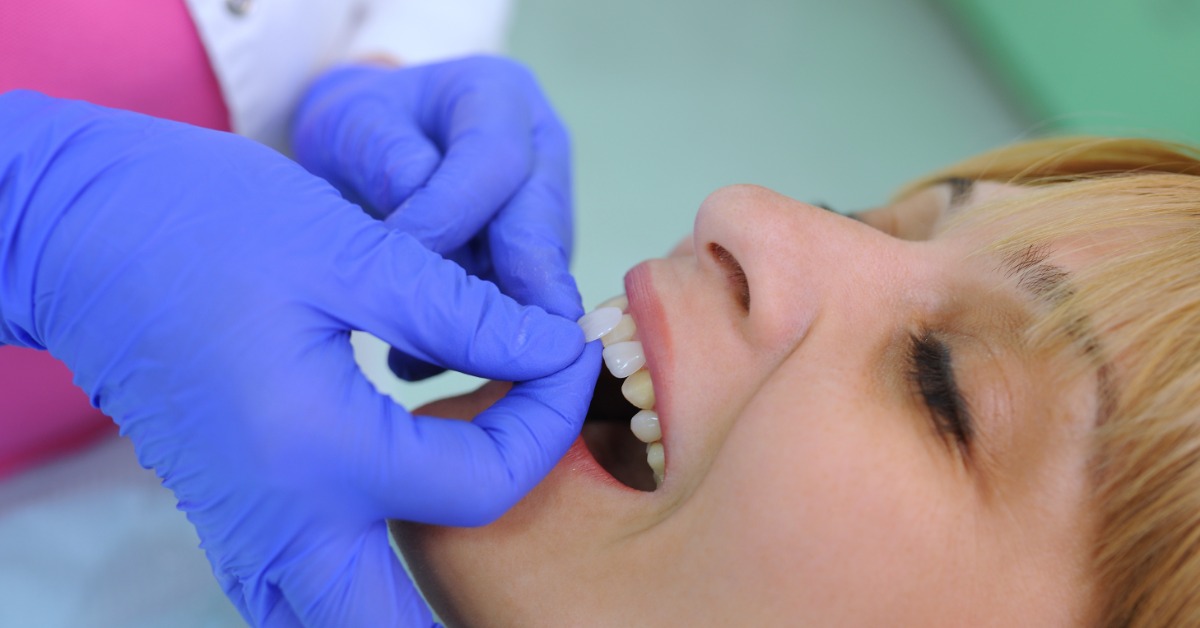 Dentist wearing blue gloves places a dental veneer on a patient's front tooth during a cosmetic dental procedure.